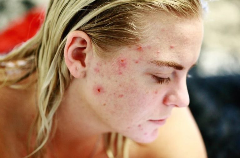 Can CBD oil help to reduce acne